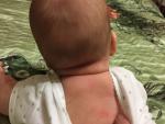 Красные пятна на спине, шее и голове у ребёнка 5 месяцев фото 1