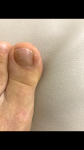 Пятнышко на ногте большого пальца ноги фото 2