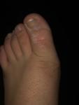 Шелушится кожа возле ногтя пальцев ног фото 1
