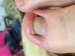 Плохой рост ногтя, на пальце ноги фото 1