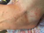 Появился дерматит на теле, больше всего высыпаний на ногах фото 1