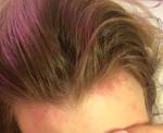 Аллергия на краску для волос фото 2