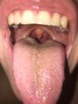 Увеличенные лимфоузлы, боль в горле, сыпь фото 1