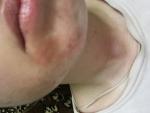 Сыпь под уголками губ фото 1