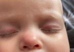 Красный круг на кончике носа у ребёнка! фото 3