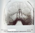 Боль посередине в области бровей + снимок рентгена фото 1