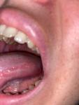 Болит язык после установки временной коронки фото 2