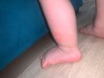 Сыпь на ножках у грудничка фото 1