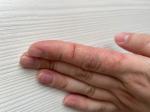 Трещины, зуд, шелушение кожи пальцев рук фото 1