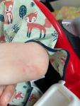 Высыпания на коже у ребёнка: локти, коленки; фото 2