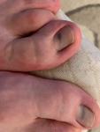 Темное пятна на ногтях больших пальцев ног фото 1