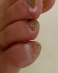 Белеет кожа вокруг ногтей на ногах фото 3