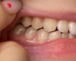 Кариес на зубах фото 2
