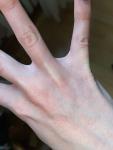 Шелушение и трещины между пальцами рук фото 2