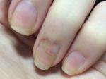 На ногте появилось покраснение в области ногтевой лунки фото 2