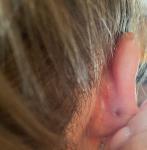 Воспаление за ухом фото 1