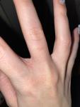 Шелушение и трещины между пальцами рук фото 1