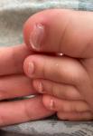 Плохие ногти на ногах у маленького ребёнка фото 1