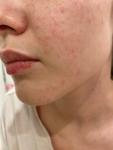 Сыпь на лице (пузырьки) аллергия? фото 1