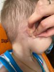 Шишка за ухом у ребёнка фото 1