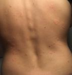 Сыпь на спине в виде красных точек и шелушений фото 1