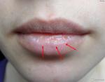 Сухость губ (см. Фото) фото 1
