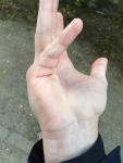 Дефект руки после травмы фото 3