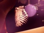 Застарелый перелом грудины с признаками неоартроза фото 3