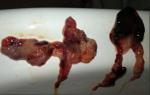 Сгусток эндометрия после Эскапела фото 1