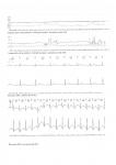 Расшифровка суточного мониторинга ЭКГ и рекомендации фото 4