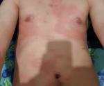 Высыпания на коже, аллергия фото 3