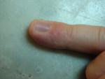 Мелкие водянистые пузырьки на пальцах рук фото 1