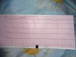 Расшифровка кардиограммы с ВСД фото 1