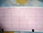 Расшифровка кардиограммы с ВСД фото 2
