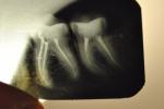 Непонятные боли в области двух зубов фото 3