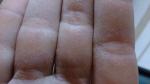 Реакция на коже пальцев рук фото 2