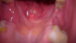 Тонзилит без боли в горле, увеличены узлы фото 2
