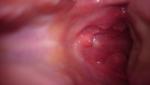 Тонзилит без боли в горле, увеличены узлы фото 1