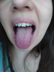 Налет на языке, кандидоз ли это, можно ли лечить зубы фото 2