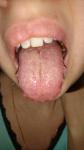 Налет на языке, кандидоз ли это, можно ли лечить зубы фото 1