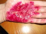 Вирусы провоцирующие острое течение кожных заболеваний фото 2