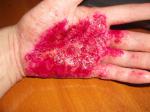 Вирусы провоцирующие острое течение кожных заболеваний фото 3