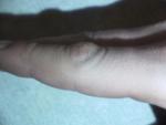 Уплотнение коже на сгибе пальца фото 2