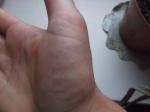 Мелкие водянистые прыщи на кистях рук не чешуться фото 4