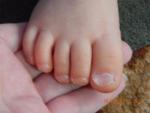 Ногти на ногах ребенка неправильной формы фото 3