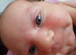 Сыпь у новорожденного фото 1