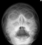 Расшифровка рентгеновского снимка носовых пазух фото 1