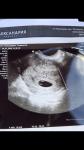 6,5 недель не видно эмбрион фото 2