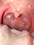 Сухой кашель в течение 1,5 месяца, хронический назофарингит после ковида фото 1