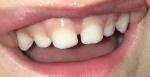 Белые пятна на молочных зубах фото 1